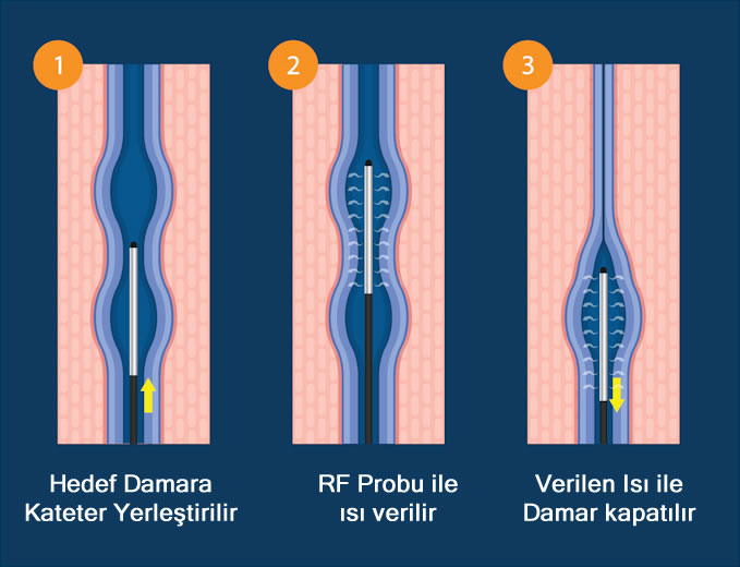 Varisler sıkça karşılaşılan bir sorun olup, hem estetik hem de