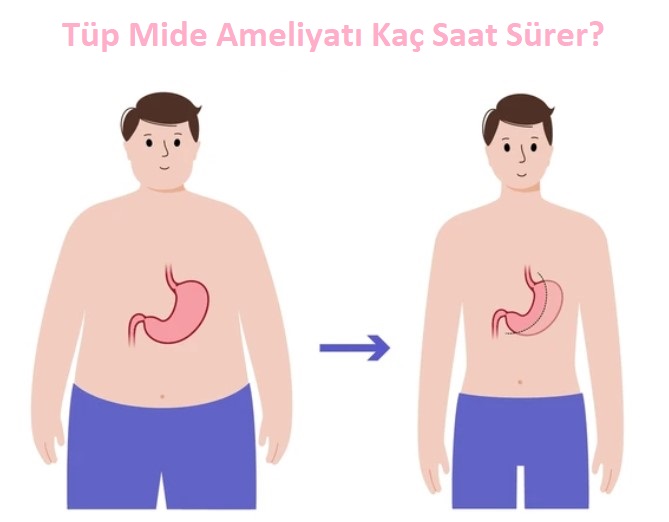   Tüp mide ameliyatı